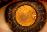 Diabetic Eye Exams